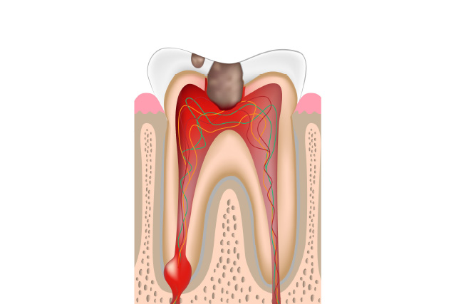 不良補綴物の除去・歯冠部の齲蝕除去